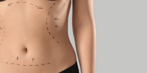 Free Liposuction Assessments for Body Contouring Near Arlington